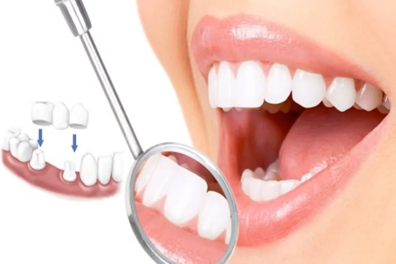 Buổi hẹn 1: Thăm khám, tư vấn và mài cùi răng