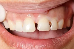 bọc răng sứ bị hỏng xử lý thế nào