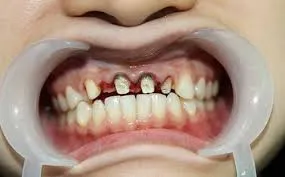 Viêm nướu, hôi miệng