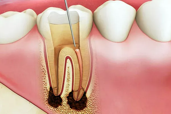 Tủy răng là gì và tại sao cần bảo tồn?