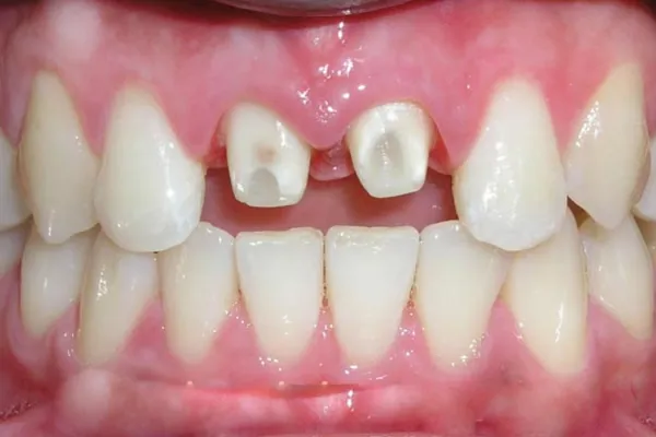 Bọc răng sứ có cần mài răng không?