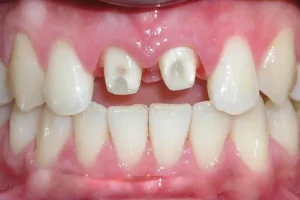 bọc răng sứ có cần mài răng không