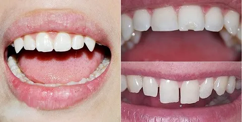 Tại sao cần mài răng khi bọc sứ?