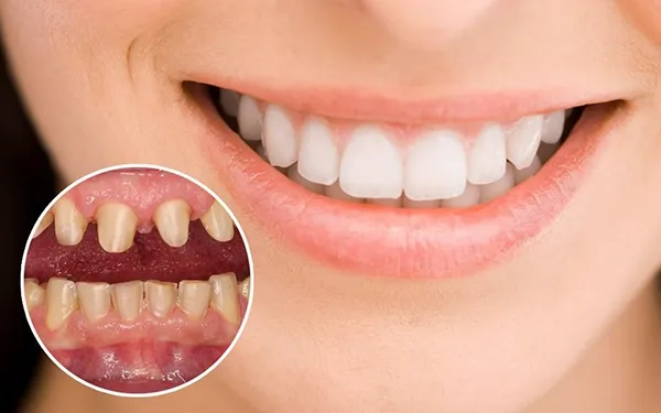 Mức độ mài răng khi bọc sứ như thế nào?