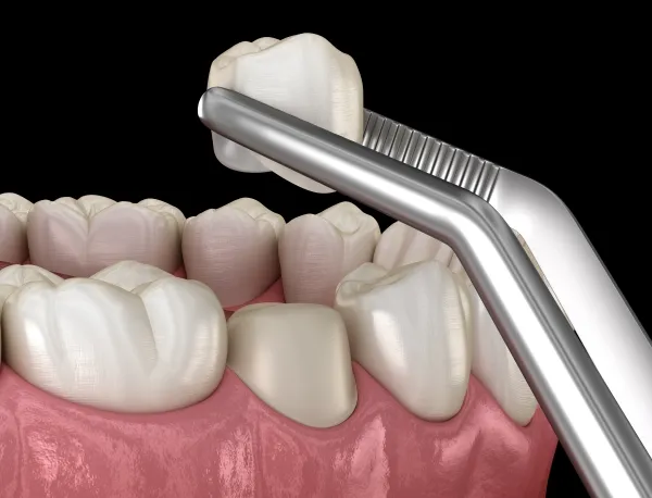 Bọc răng sứ có đau không? Mức độ khó chịu thường gặp