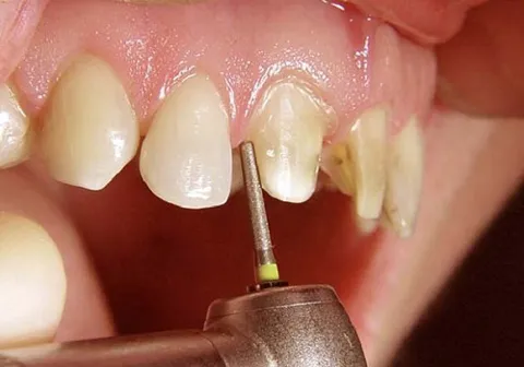Khi điều trị bệnh lý răng miệng (nếu có)