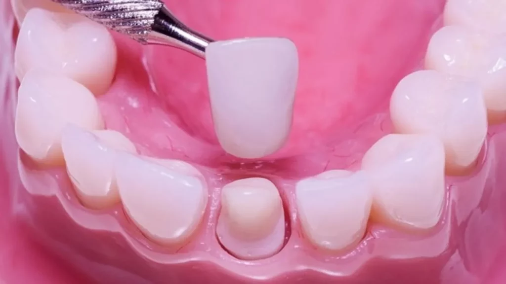 bọc răng sứ có hại gì không