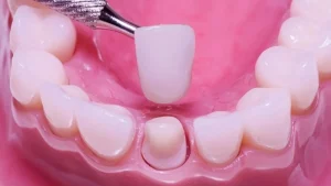 bọc răng sứ có hại gì không
