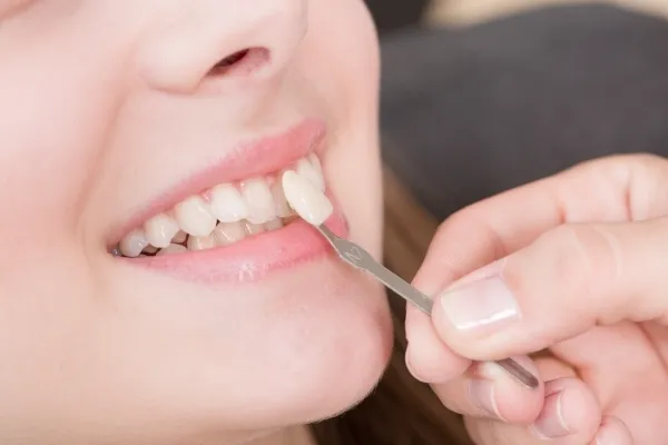 Những tác hại tiềm ẩn của việc bọc răng sứ (nếu không đúng cách)