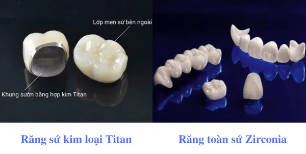 Loại răng sứ lựa chọn