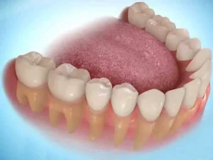 bọc răng sứ hàm dưới