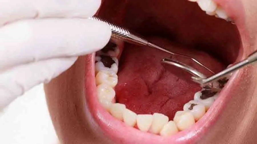 Khi nào nên bọc răng sứ hàm dưới?