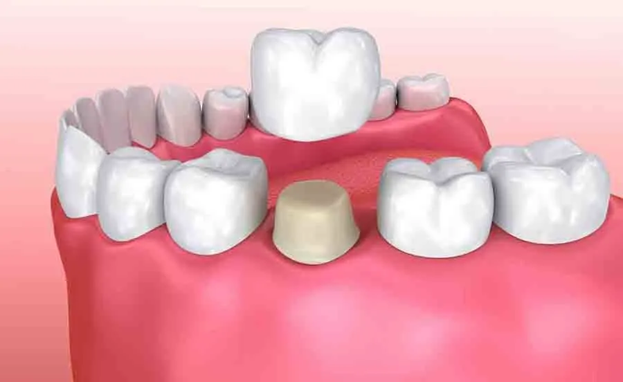 Răng bị sứt mẻ, nứt vỡ hoặc vỡ lớn