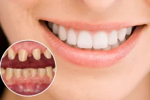bọc răng sứ hàm trên