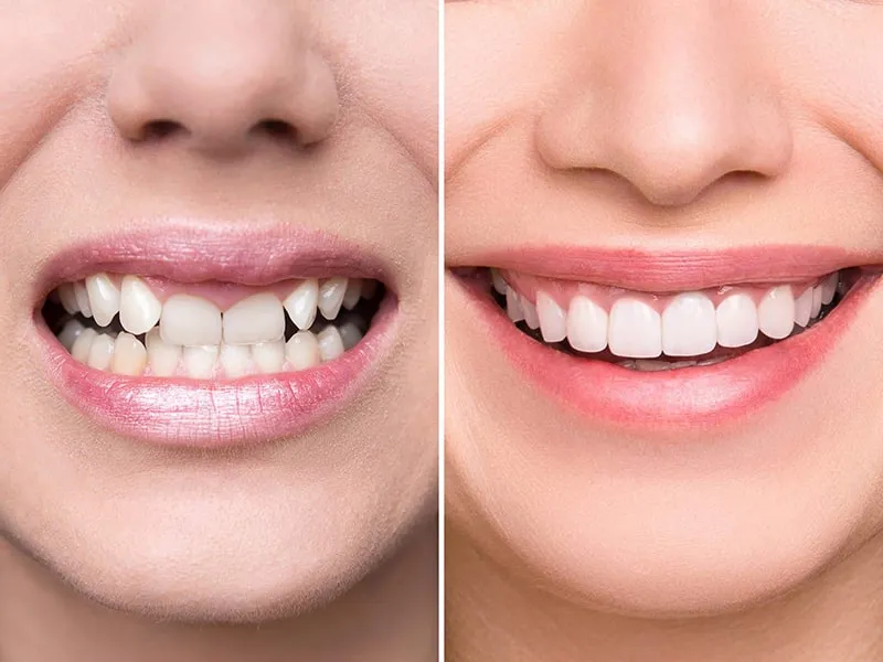 Tại sao nên bọc răng sứ hàm trên?