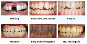 bọc răng sứ là gì