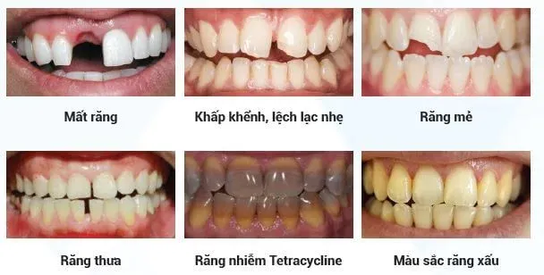 bọc răng sứ là gì