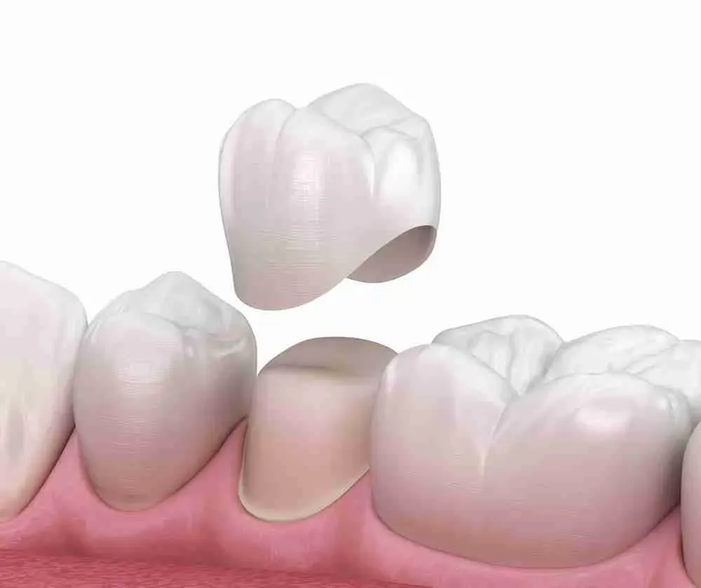 Khi nào nên bọc răng sứ?