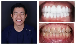 bọc răng sứ nguyên hàm