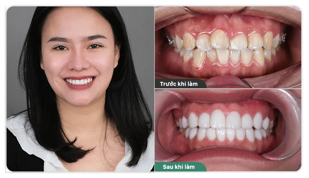 Khi nào nên cân nhắc bọc răng sứ nguyên hàm?