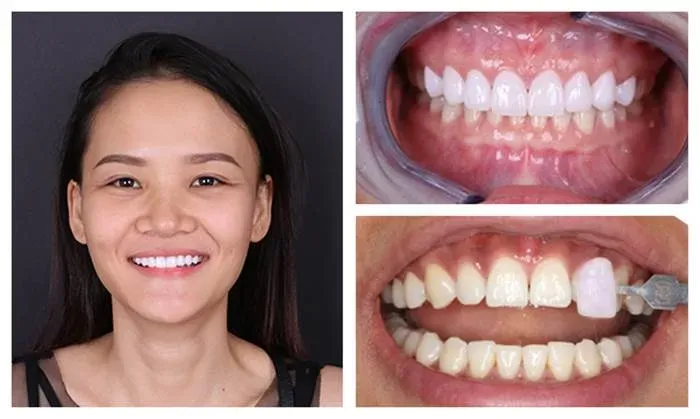 Răng bị nhiễm màu nặng, ố vàng không thể tẩy trắng