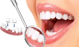 bọc răng sứ thẩm mỹ