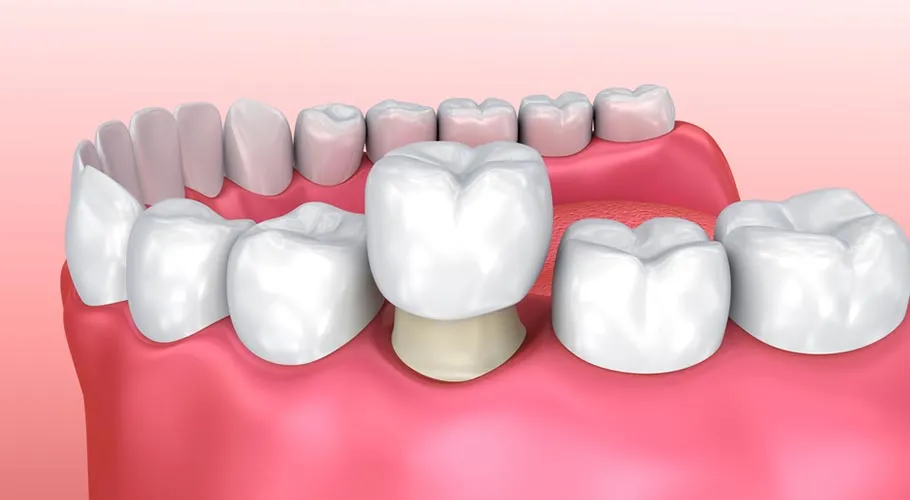 Răng bị ố vàng, xỉn màu nặng không thể tẩy trắng