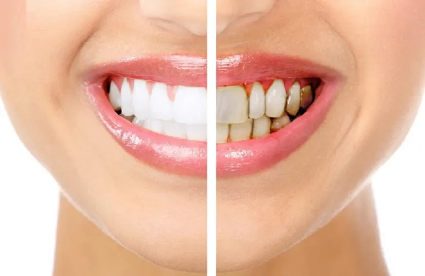 Lợi ích khi chọn bọc răng sứ trả góp
