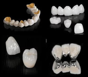 các loại răng sứ phổ biến hiện nay