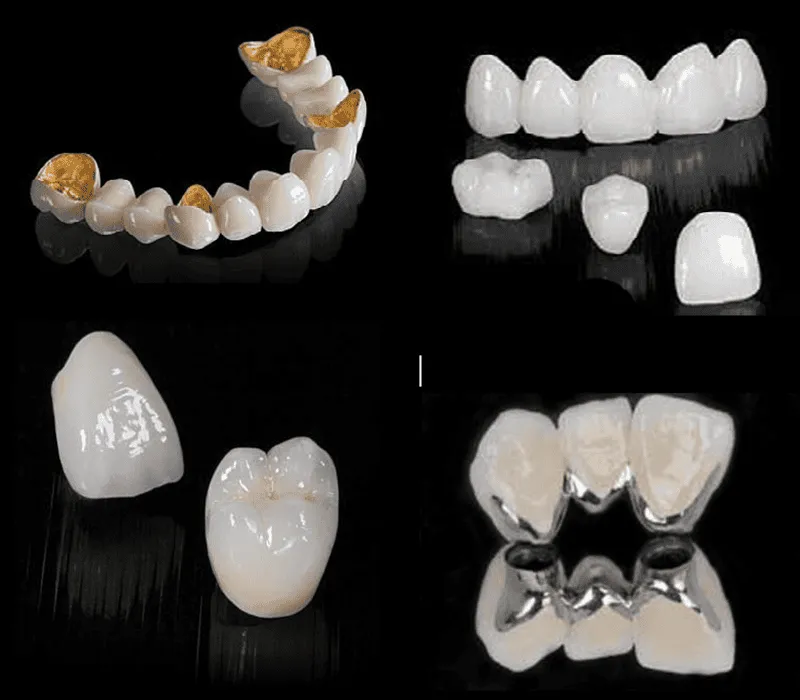 các loại răng sứ phổ biến hiện nay
