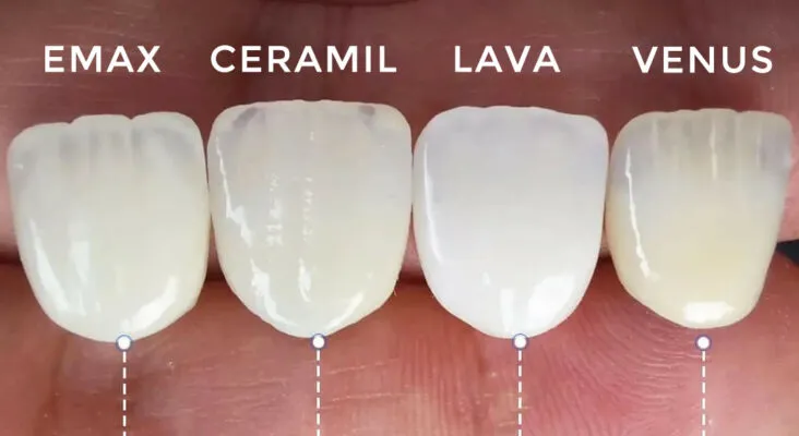 Ưu điểm của răng sứ kim loại