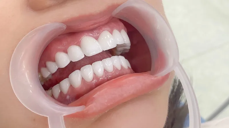 Vệ sinh răng miệng đúng cách và đều đặn