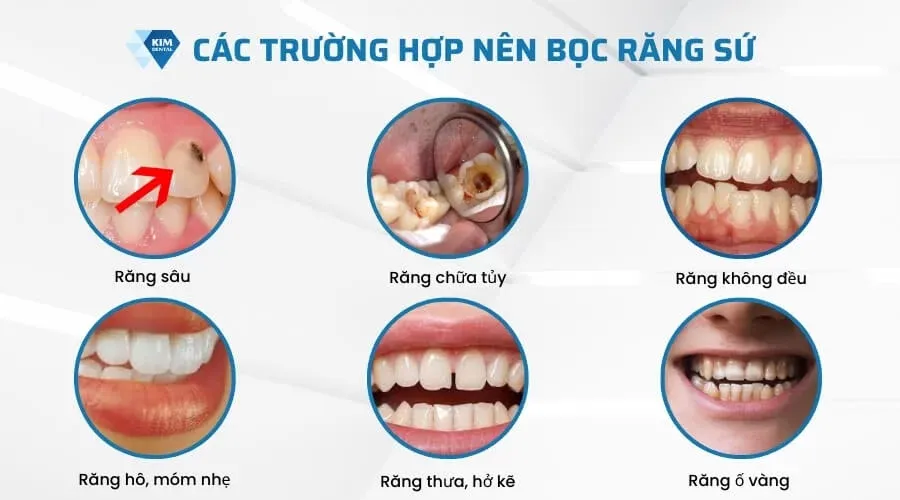 Bọc răng sứ là gì?
