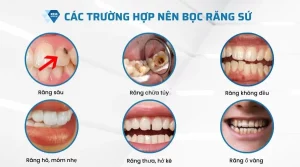 có nên bọc răng sứ không
