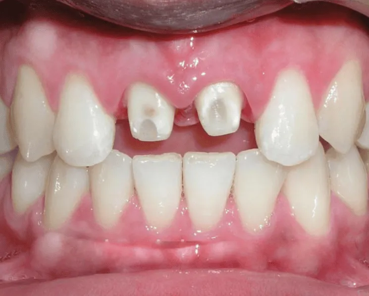 Ưu điểm vượt trội của bọc răng sứ