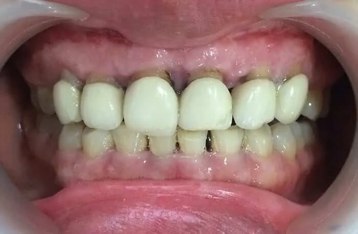 Đánh răng: Yếu tố không thể thiếu để duy trì răng sứ bền đẹp