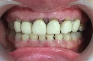 đánh răng có làm hỏng răng sứ không