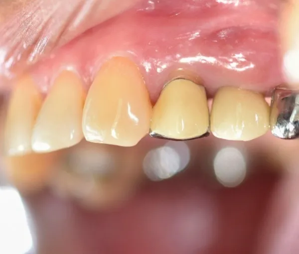 Những trường hợp đánh răng "sai cách" có thể gây hại cho răng sứ