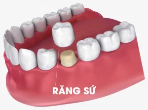 nên bọc răng sứ ở đâu uy tín