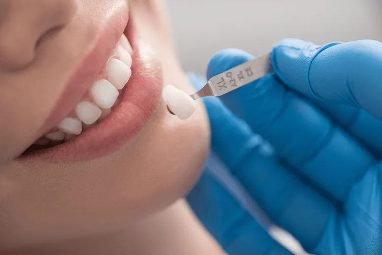 Các loại răng sứ phổ biến hiện nay