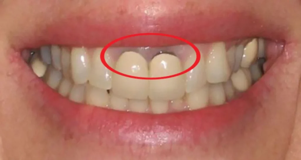 Răng sứ bị đen viền nướu là gì?