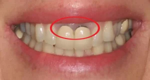 răng sứ bị đen viền nướu