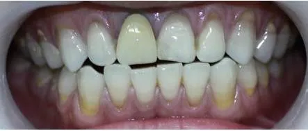 Nguyên nhân răng sứ bị đen viền nướu