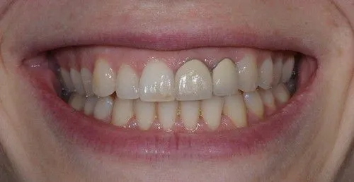 Kỹ thuật mài răng sai và lắp răng sứ không khít sát