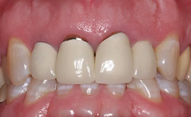 Hiểu về cảm giác ê buốt sau khi bọc răng sứ