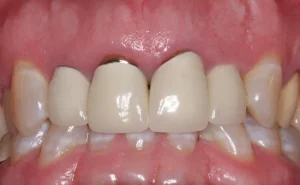răng sứ bị ê buốt lâu ngày