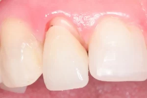 răng sứ bị lung lay