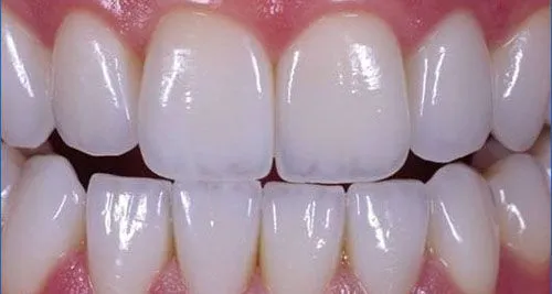 Các nguyên nhân chính khiến răng sứ bị lung lay