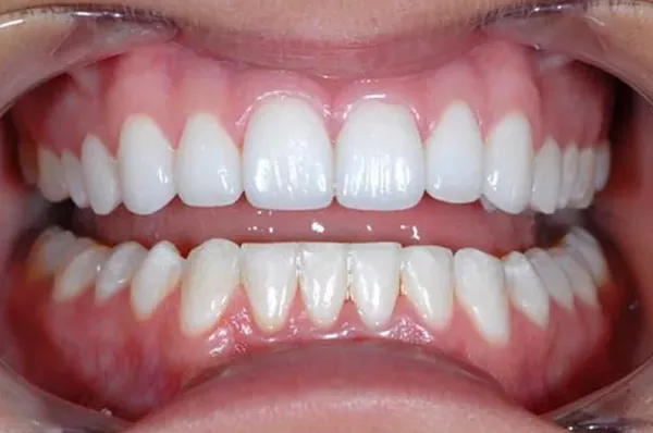 Keo dán răng sứ bị bong hoặc lão hóa