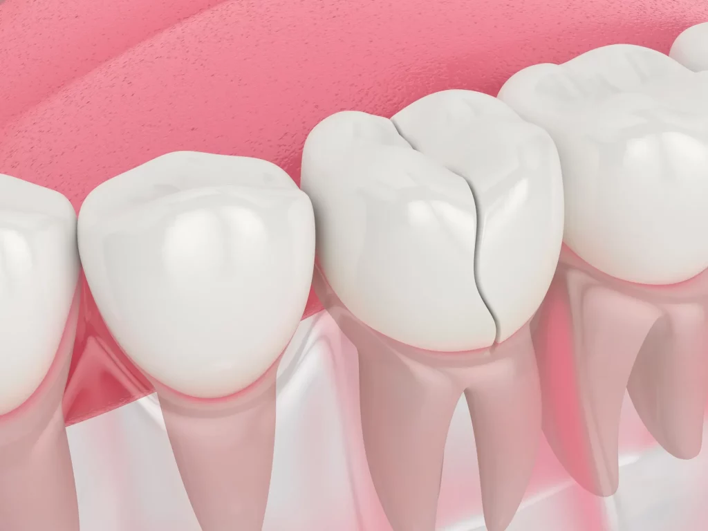 răng sứ bị vỡ phải làm sao